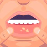 A Understanding and Managing Mouth Ulcers: Tips for Oral Comfort