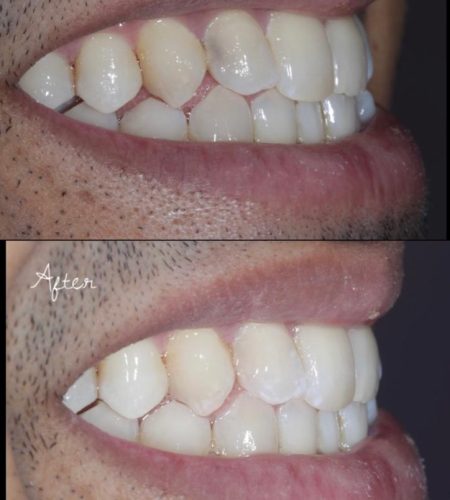 Composite class 3 restoration