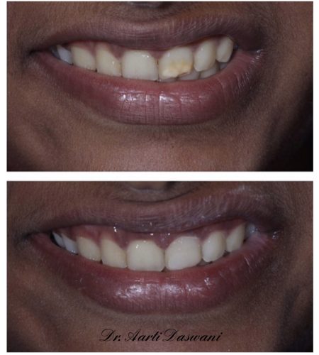 Discoloration masked with composites