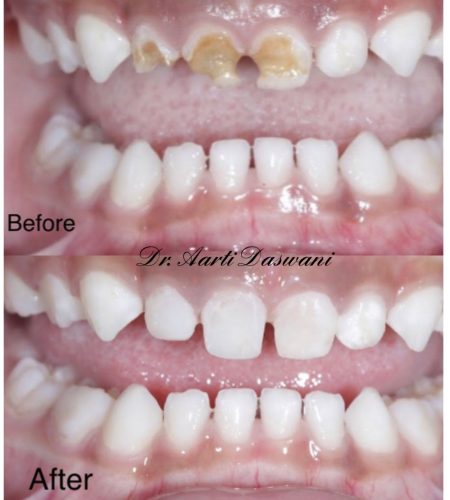 Magic of composites in milk teeth