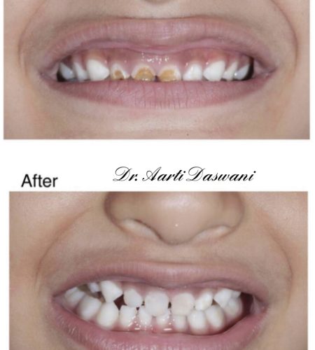 Makeover of kid's smile