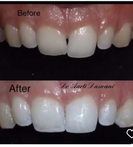 Smile correction with whitening and composite