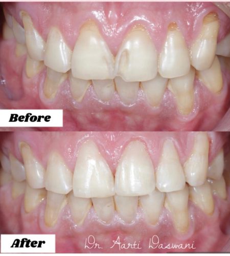 Smile makeover with composites